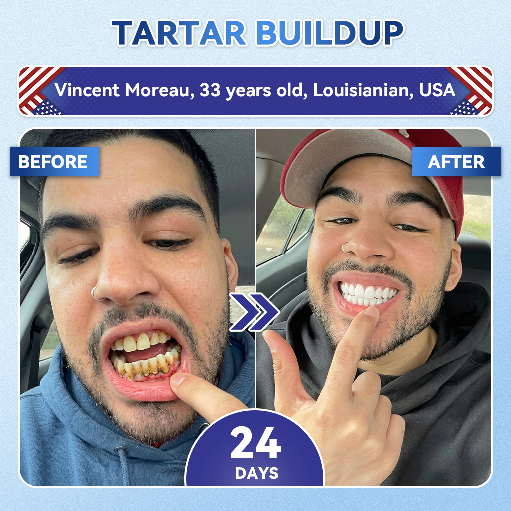 𝐆𝗹𝐢𝙢𝙢𝐞𝐫𝗹𝙮® 𝐓𝐢𝐝𝙚𝐠𝗜𝐮𝐬𝐢𝐛 𝐓𝐨𝐨𝐭𝐡 & 𝐆𝐮𝐦 𝐑𝐞𝐩𝐚𝐢𝐫 𝐌𝐢𝐜𝐫𝐨𝐧𝐞𝐞𝐝𝗜𝐞 𝐏𝐚𝐭𝐜𝐡 | 🦷𝐀𝐝𝐯𝐚𝐧𝐜𝐞𝐝 𝐒𝐭𝐞𝐦-𝐂𝐞𝐥𝐥 𝐀𝐜𝐭𝐢𝐯𝐚𝐭𝐢𝐨𝐧 𝐓𝐞𝐞𝐭𝐡 𝐒𝐭𝐫𝐢𝐩𝐬🆕(𝐑𝐞𝐛𝐮𝐢𝐥𝐝 𝐄𝐧𝐚𝐦𝐞𝐥 & 𝐃𝐞𝐧𝐭𝐢𝐧 • 𝐒𝐭𝐫𝐞𝐧𝐠𝐭𝐡𝐞𝐧 𝐆𝐮𝐦𝐬 • 𝐄𝐫𝐚𝐝𝐢𝐜𝐚𝐭𝐞 𝐓𝐚𝐫𝐭𝐚𝐫 & 𝐎𝐝𝐨𝐫 • 𝐒𝐭𝐨𝐩 𝐓𝐨𝐨𝐭𝐡 𝐒𝐞𝐧𝐬𝐢𝐭𝐢𝐯𝐢𝐭𝐲)
